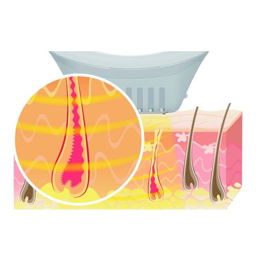 Appareil D'epilation Semi-permanente À Lumière Pulsée - Ipl 10000