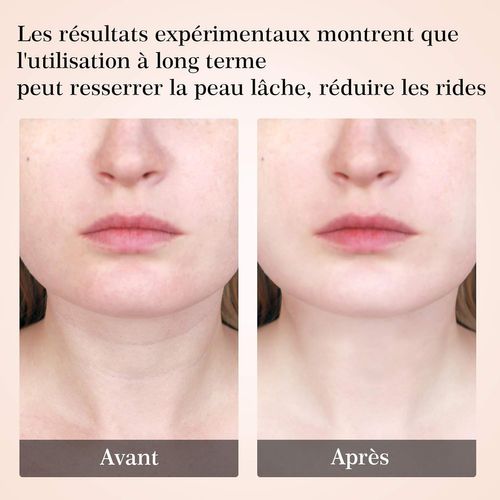 Appareil Anti Rides Visage, Appareil De Beauté,145－115－60mm. Soins De La Peau Dispositif